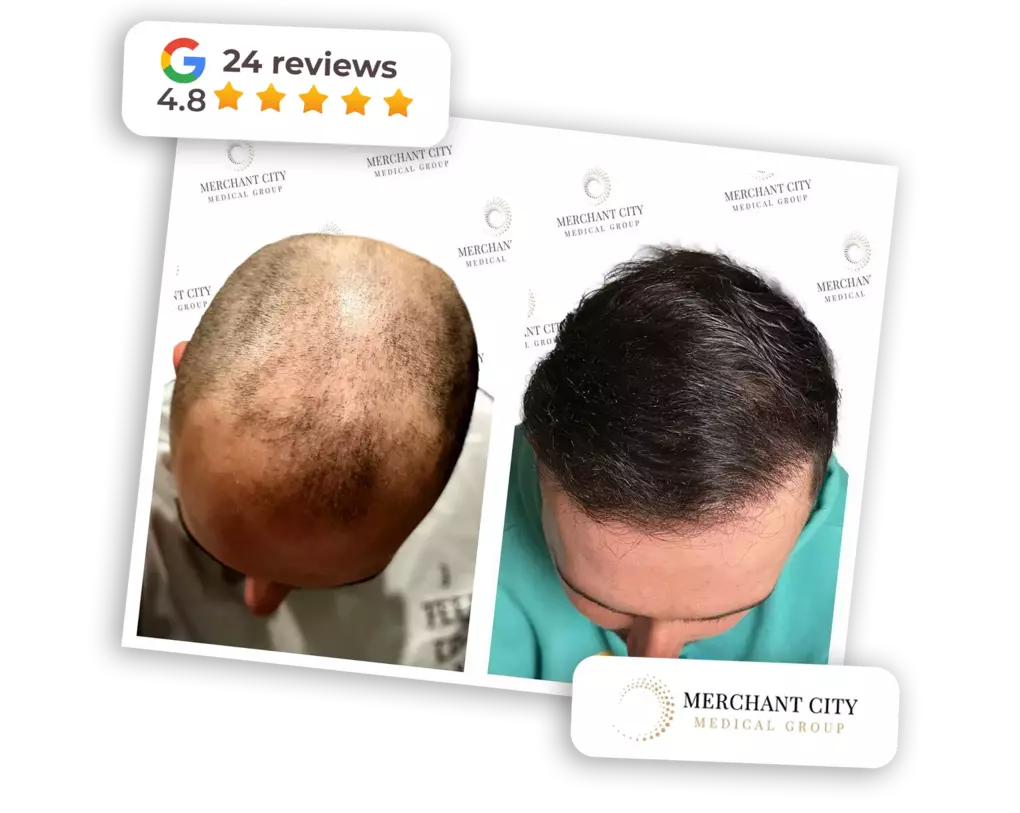 Sapphire FUE has amazing results.