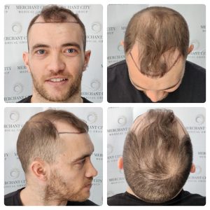 before the hair transplant