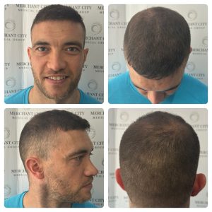 After the hair transplant