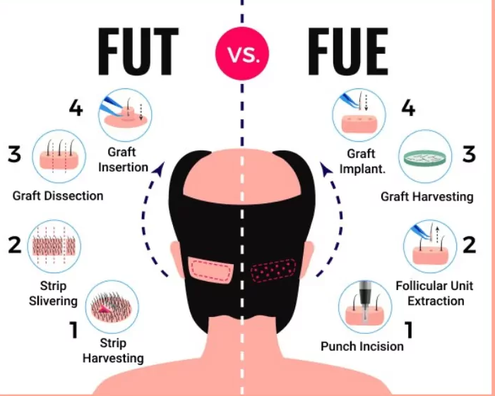 FUT vs FUE