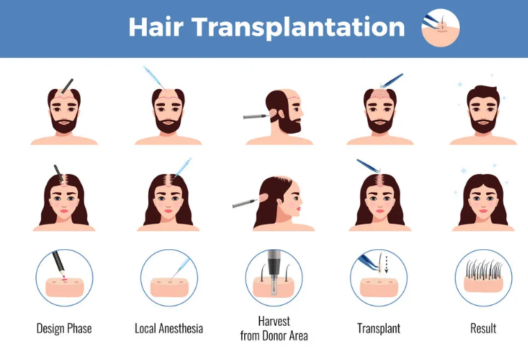 Hair Transplant Procedure