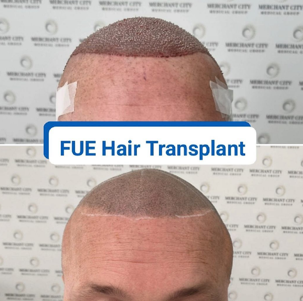 A successful FUE transplant