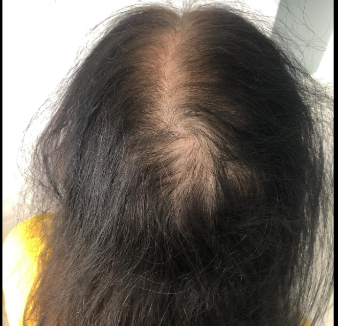 A woman experiencing hair loss