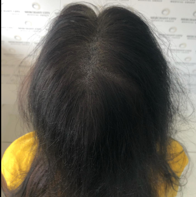 A woman experiencing hair loss