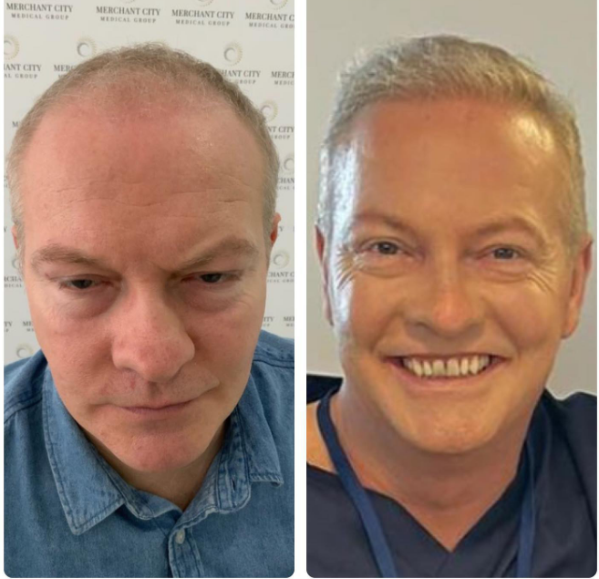 Simon Weir, a Scottish actor, after FUE procedure