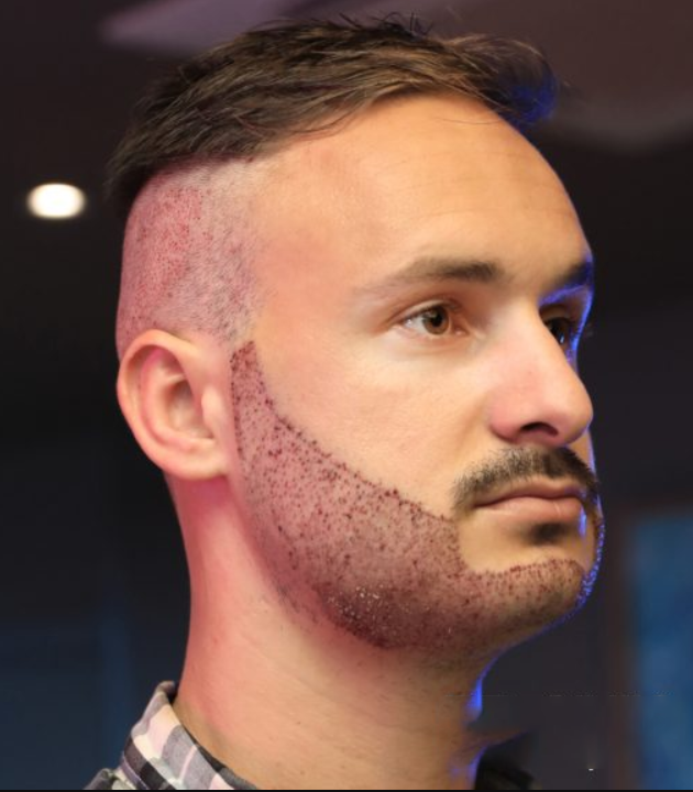 Beard Transplant_2
