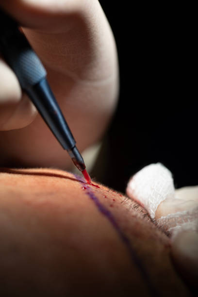 The doctor is creating space for hair follicles on the patient’s scalp using a medical instrument. This step is crucial in the hair transplant process. The photo highlights the precision and care required during the procedure