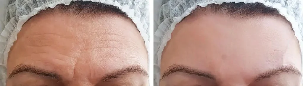 3brow-lift1_hqc