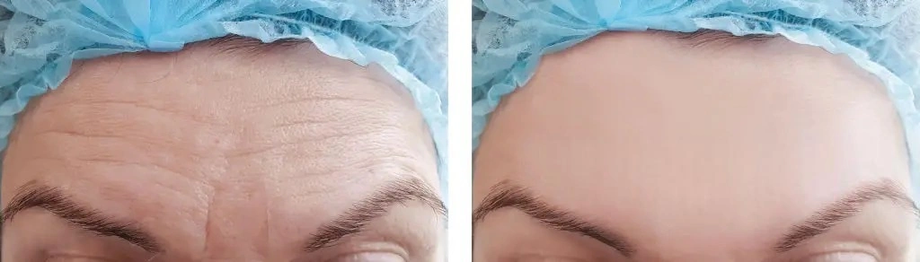 3brow-lift2_hqc