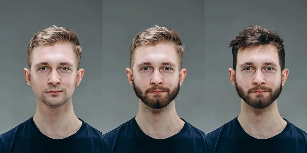 beard-transplant2 _hqc