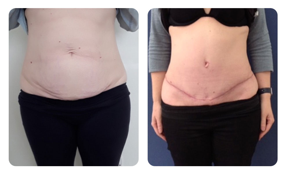 tummy-tuck-before-after-1