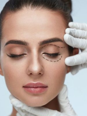 BLEPHAROPLASTY