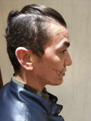 Beard Hair Transplant_1