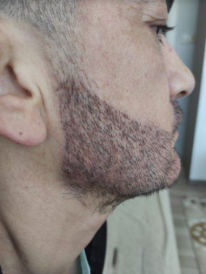 Beard Hair Transplant_2