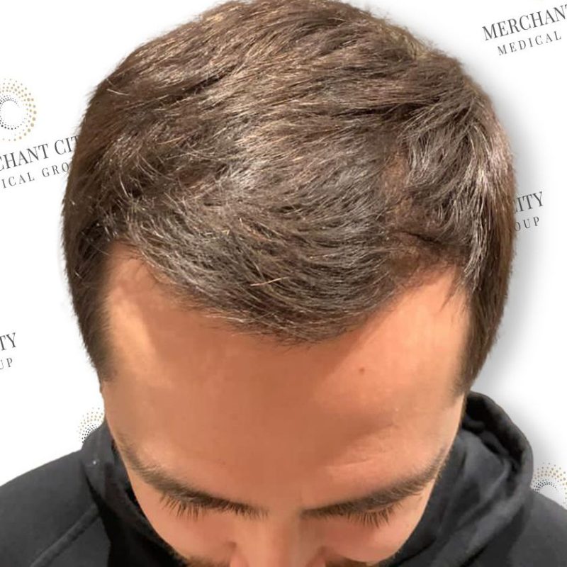 Consider These Factors Before Getting a Hair Transplant