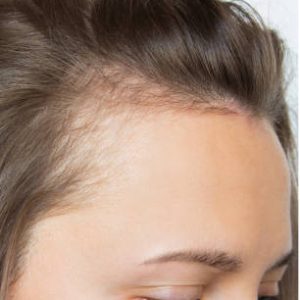 Environmental Pollutants_1 Cropped before and after head shot of a young woman with bald patches on her forehead and temples. Baldness. Close-up, side view. Hair care and treatment concept. Hair loss, hair extensions, alopecia.