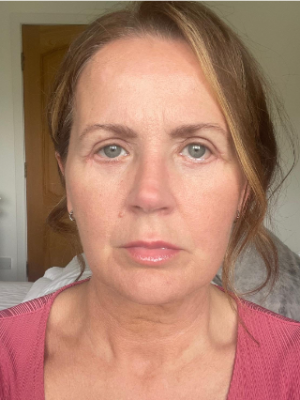 Eyelid Surgery_2