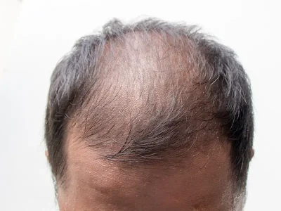 Why Genetic Factors Cause Hair Loss in Men
