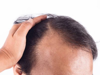 Bald head of young man o white background